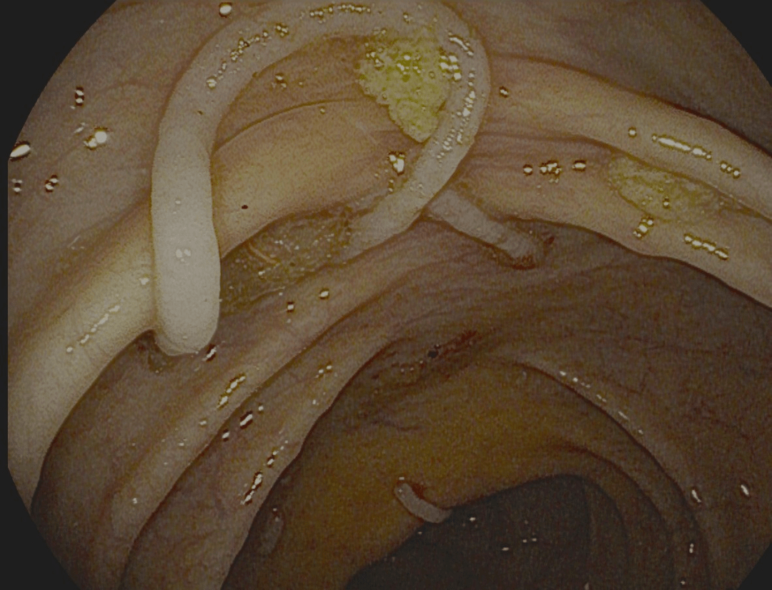 肠道蛔虫感染图片