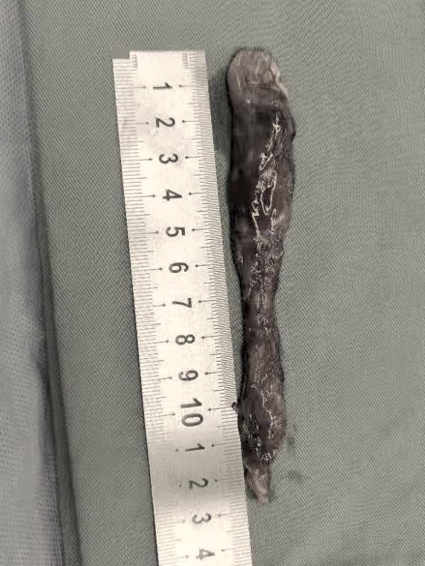 肿瘤|腰痛十年，竟是脊髓内长出狭长肿瘤