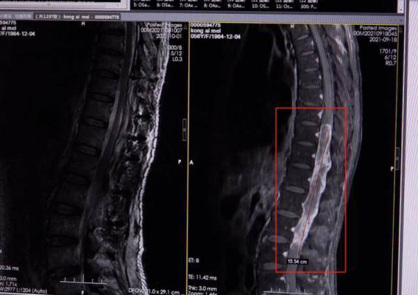 腊肠|阿姨腰痛十来年，体内竟长出一条“广式腊肠”险截瘫！医生紧急提醒