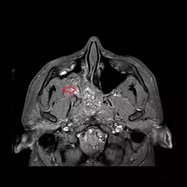 鼻咽血管纤维瘤