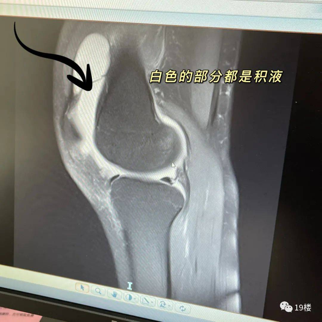 膝盖|23岁杭州姑娘因为裤子太短…进了医院