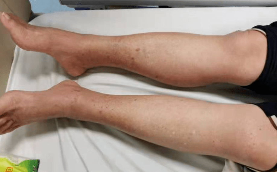 病例|慎买！女子自行买药治痛风，全身皮疹险丧命