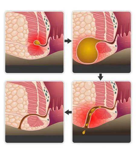 为瘘管周围皮肤变色,表皮脱落,凹陷变形,触及条索状硬结通向肛门内