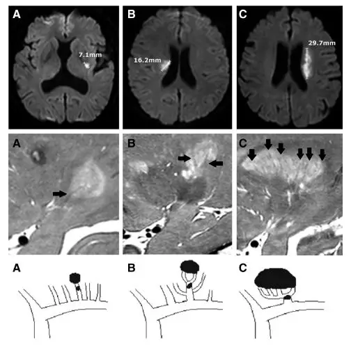 大脑|“腔隙性脑梗死”这个临床诊断,可以慢慢作古了