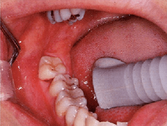 你真的掌握牙周袋探针深度了么