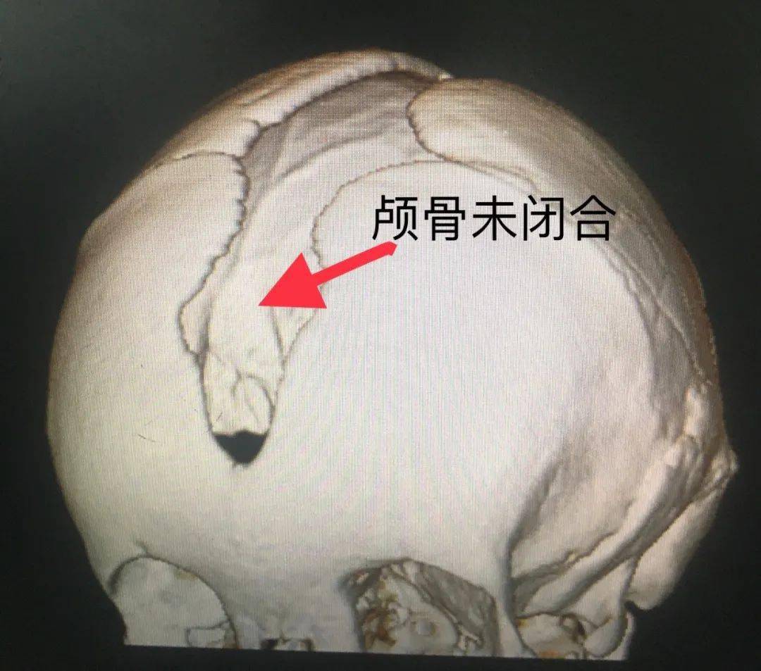 稳定有很宽的缝隙但由于患者颅骨骨缝发育不全并未完全闭合头颅双源ct
