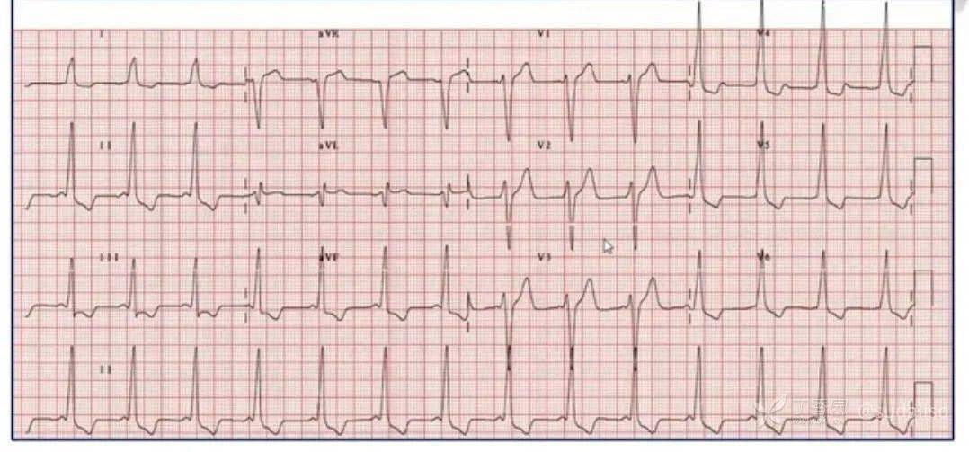 8 个预激综合征心电图,看完对「旁道迷路」不再困惑