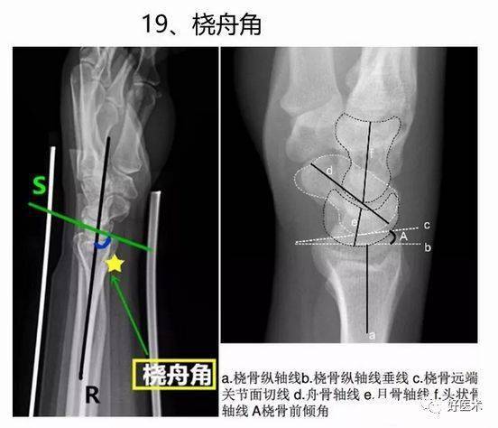 橈舟角即在腕關節側位片橈骨與舟骨(掌側與背側)中軸線的夾角.