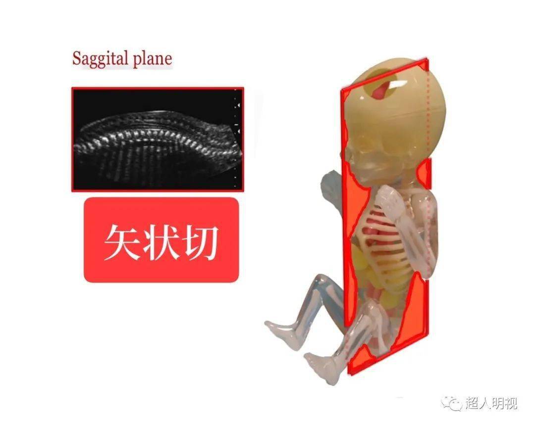 畸形胎儿脊柱弯曲图片