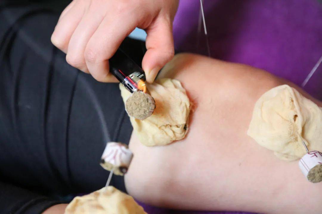 浅针疗法不同于其它的针刺疗法,是指把针尖抵于经脉腧穴皮表上而未刺