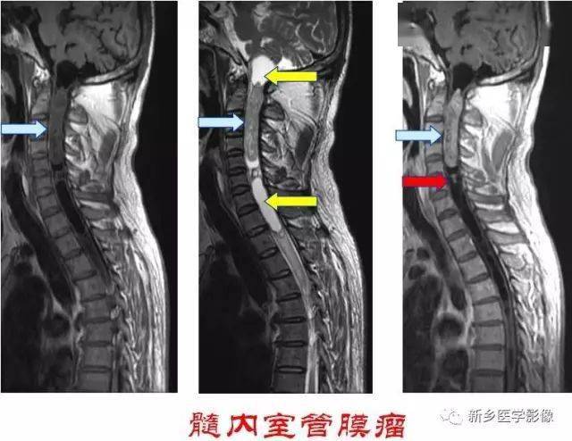 椎管肿瘤定位示意图 髓外硬膜外肿瘤 常见病例:转移瘤 其他病例:神经
