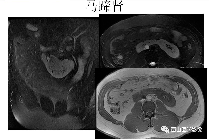 泌尿系及男性生殖系統常見病mr診斷