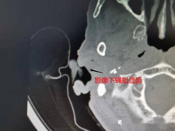 虫体|头皮发麻！80岁老人总是耳朵疼，医生一看：20条活蝇蛆