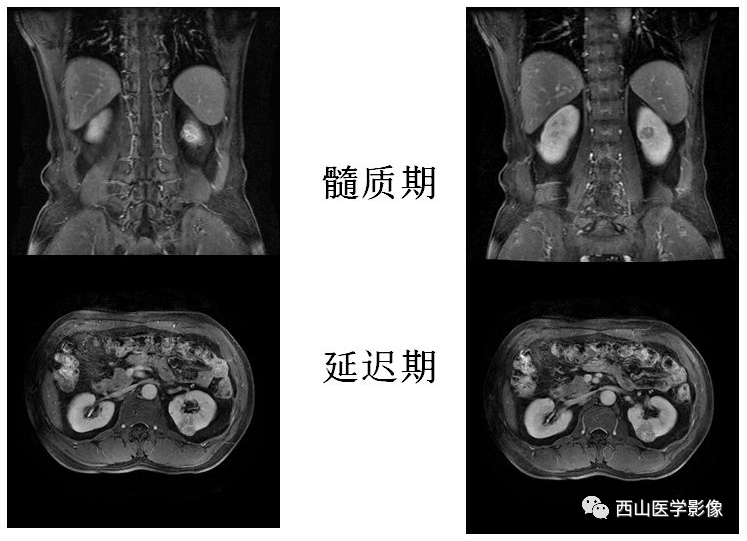 泌尿系及男性生殖系統常見病mr診斷