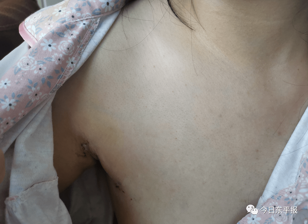 乳头缩小术疤痕图片