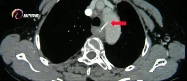 食道|警惕！鱼刺卡喉险丧命？就是因为用了这个“土办法”……