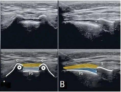 超声征象61蛙眼征