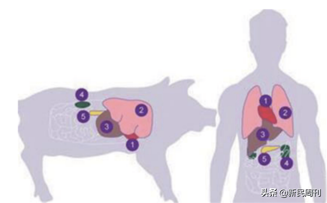 首例|世界首例猪肾移植人体成功，作秀大于临床应用？