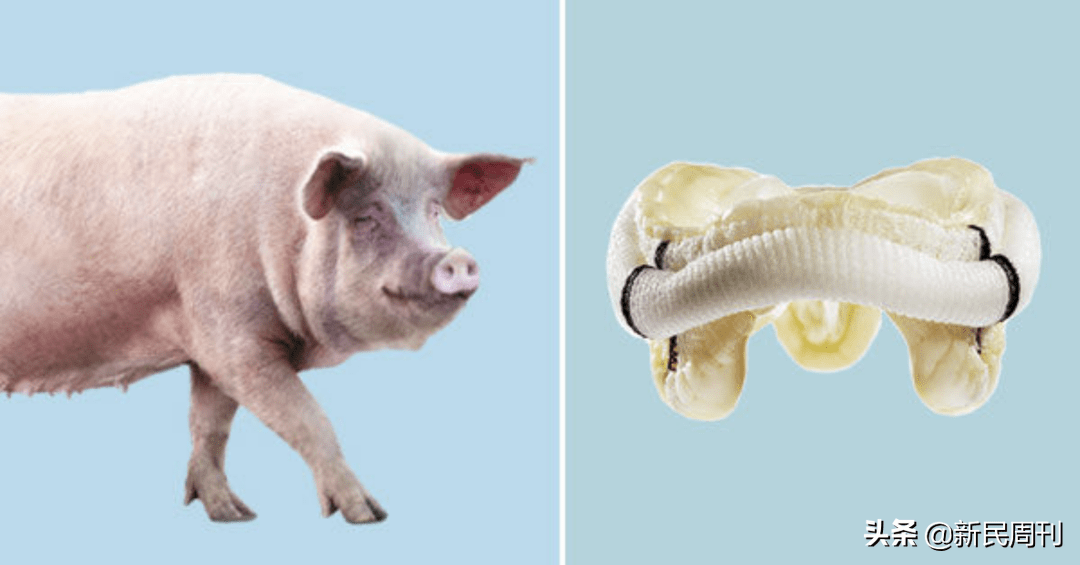 首例|世界首例猪肾移植人体成功，作秀大于临床应用？