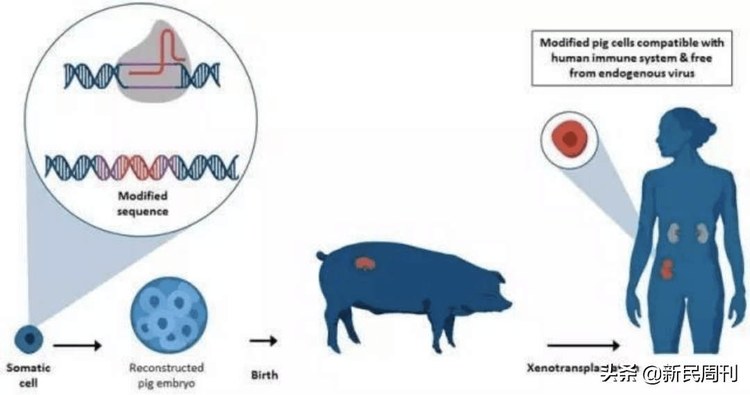 首例|世界首例猪肾移植人体成功，作秀大于临床应用？