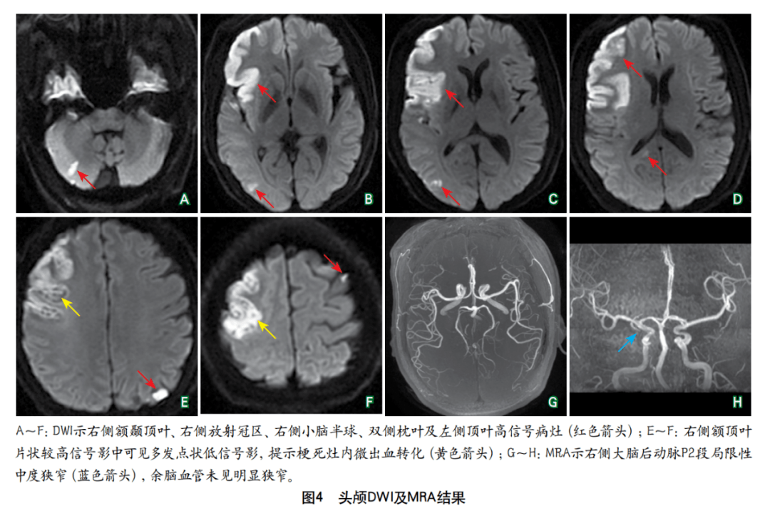 综合征|以多流域脑梗死为特征的肺癌继发特鲁索综合征1例并文献复习