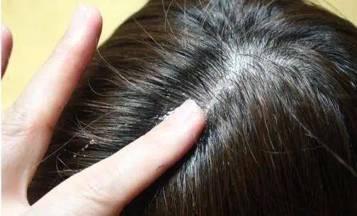 洗发|吃味精会让人掉头发？关于脱发的谣言，你信了几个