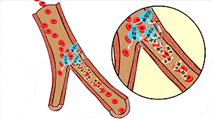 脑卒中发病急,来势凶,只有4.5小时黄金抢救时间
