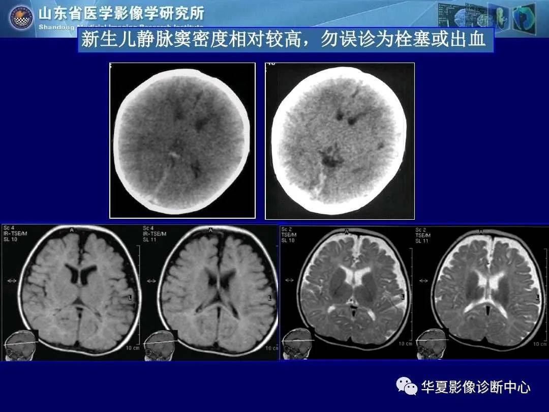 诊断|缺血性脑血管病的影像诊断