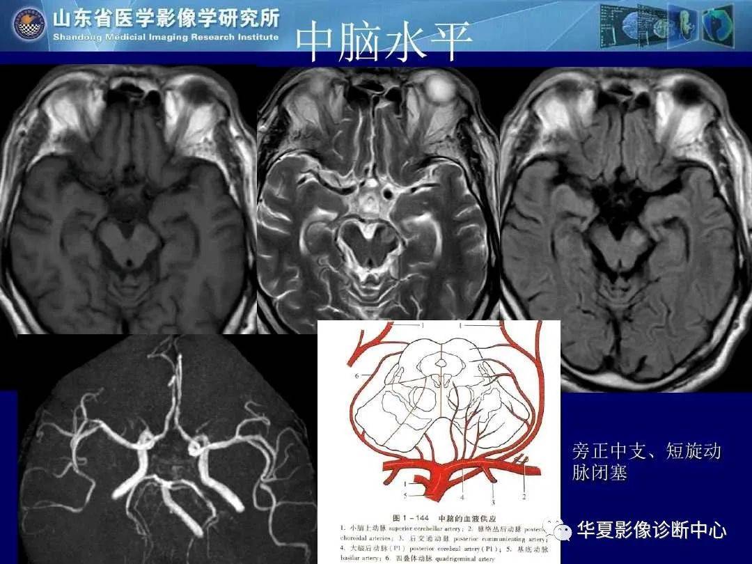 诊断|缺血性脑血管病的影像诊断