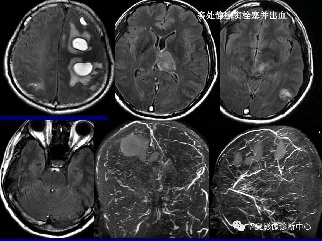 诊断|缺血性脑血管病的影像诊断