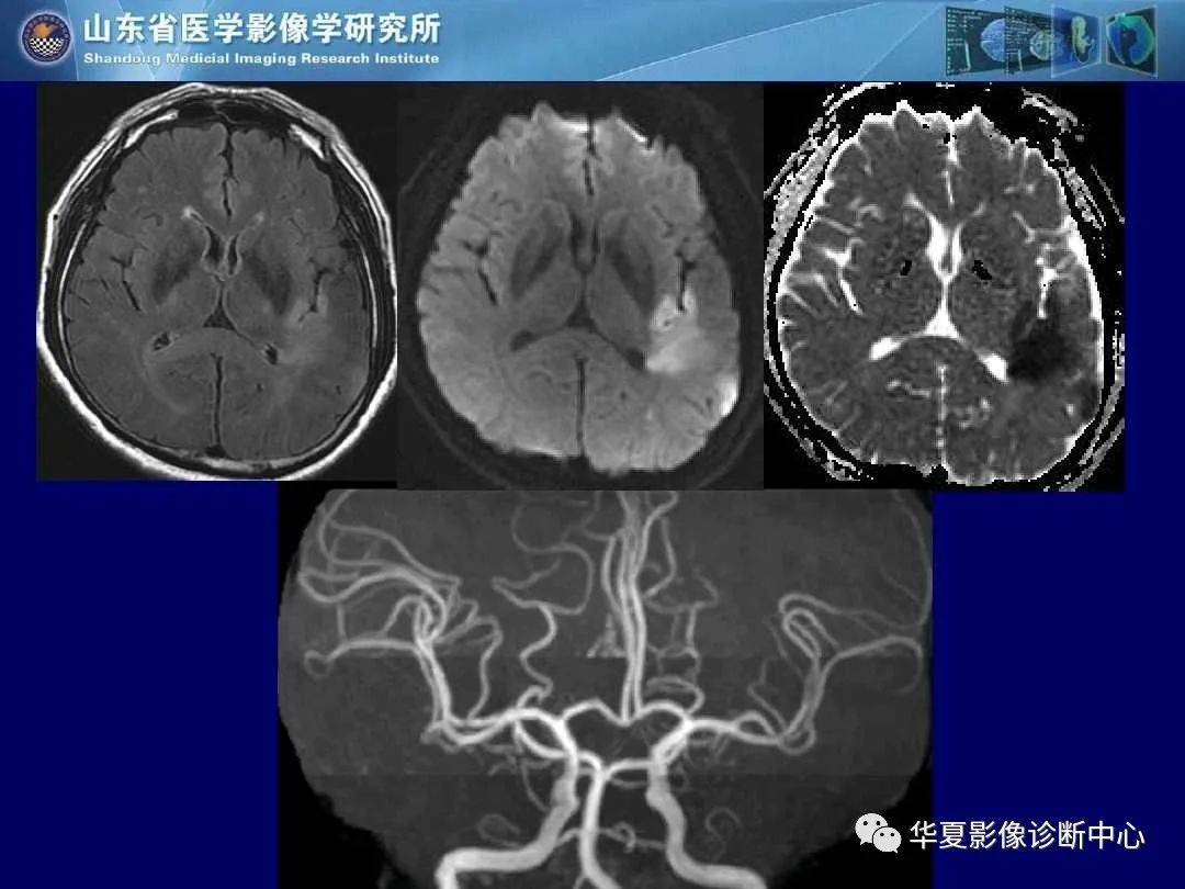 诊断|缺血性脑血管病的影像诊断