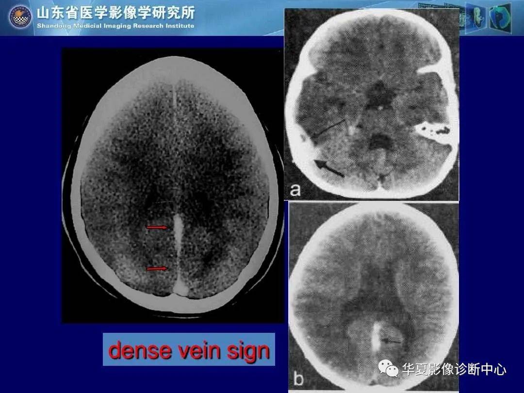 诊断|缺血性脑血管病的影像诊断