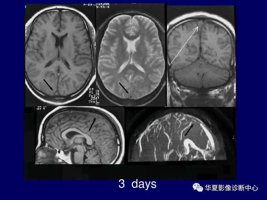 诊断|缺血性脑血管病的影像诊断