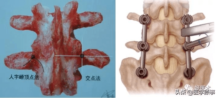 椎弓根的影像解剖图图片