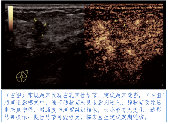 乳腺癌發病率逐年攀升快來簡醫做個乳腺超聲造影檢查健康科普