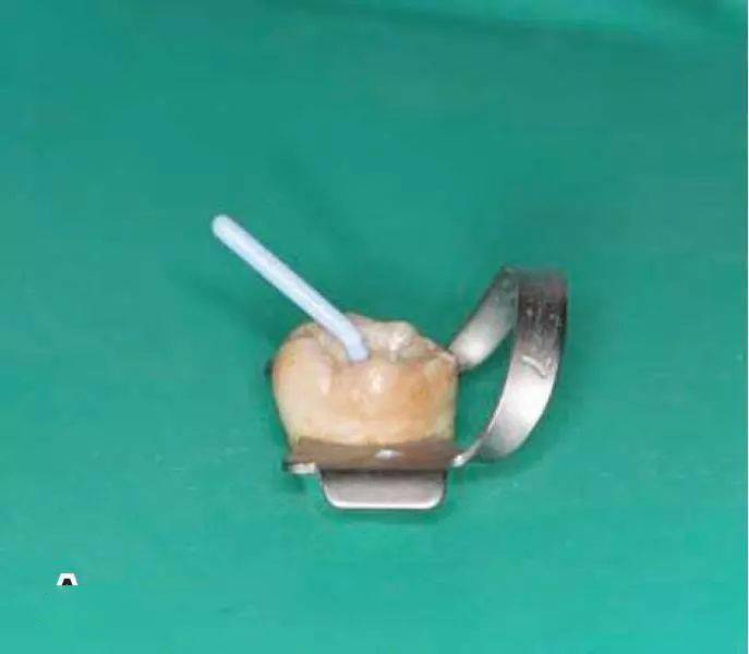 热牙胶充填术操作全图解