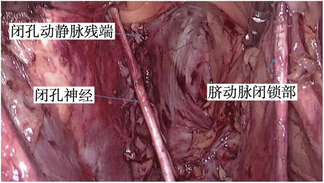 骶正中动脉图片图片