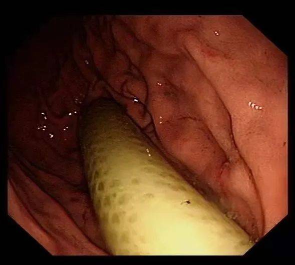 男子|男子胃里取出衣架、塑料管！在肚里待了3个月