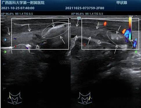 甲状软骨超声图像图片