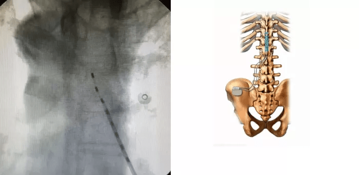 神经性|男子身上“生蛇”，偏方治疗后突然晕倒住进ICU！这种病近期高发
