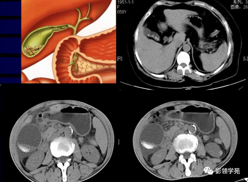 胆道系统ct解剖图图片