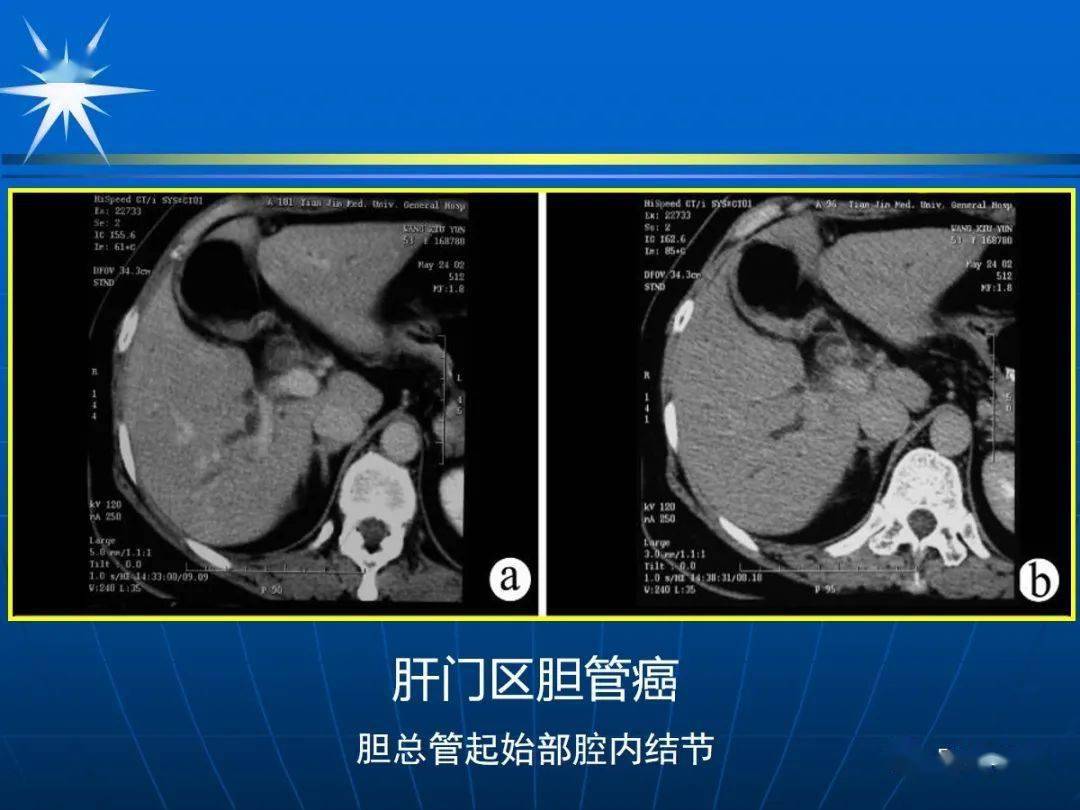 胆道系统ct解剖图图片