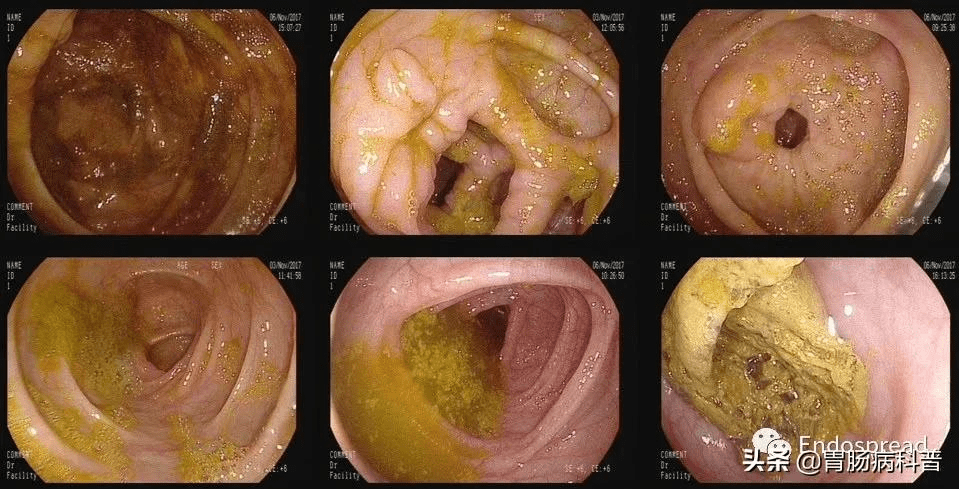 肠镜排泄后的标准图片图片