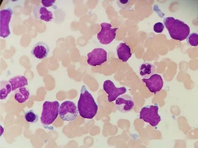 骨髓涂片b超检查淋巴细胞甲功 肿瘤标志物免疫球蛋白 补体凝血检查