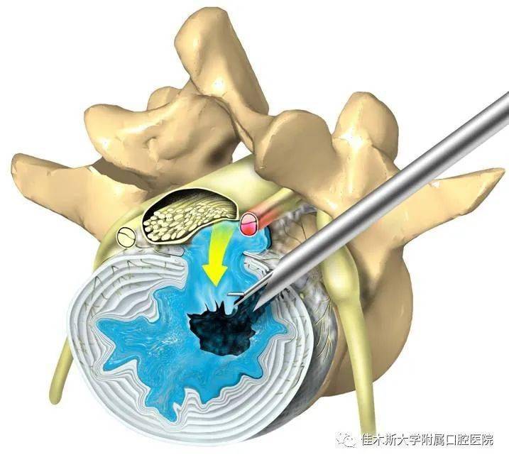 椎间孔有什么通过图片