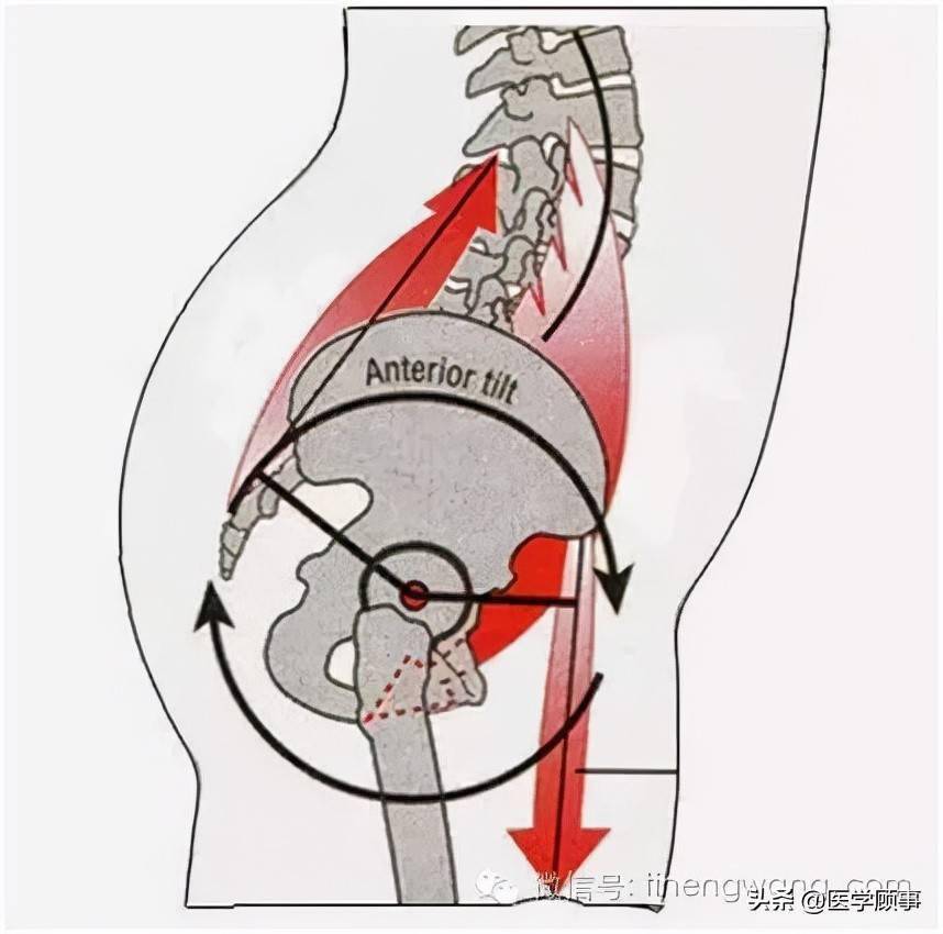 骨盆前移肌肉图片