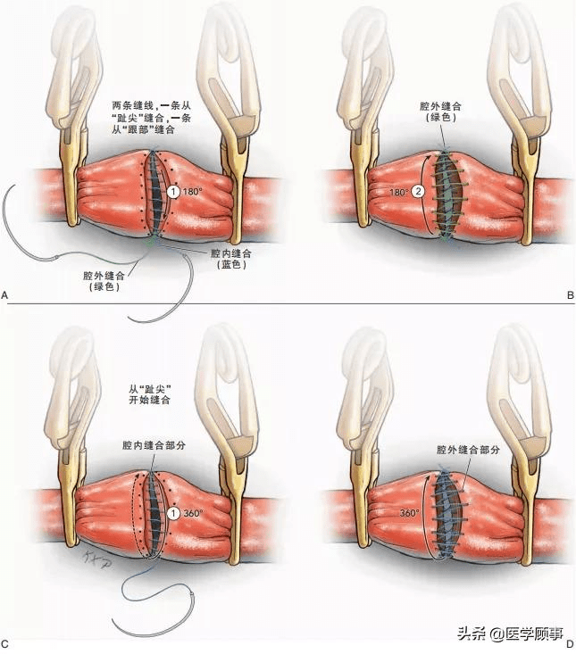 动脉末端先缝合一针锚定结,用入腔针穿入内腔,在腔内连续缝合直至另