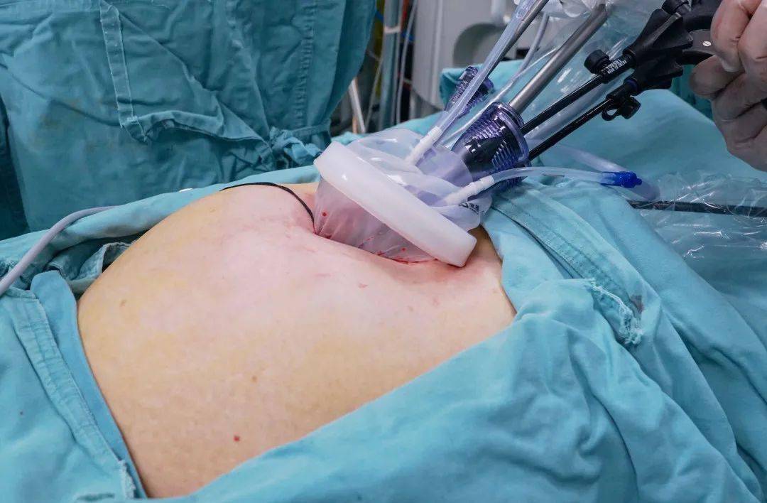 八旬娭毑腹大如怀胎十月极微创手术抽出4000毫升囊液成功减负