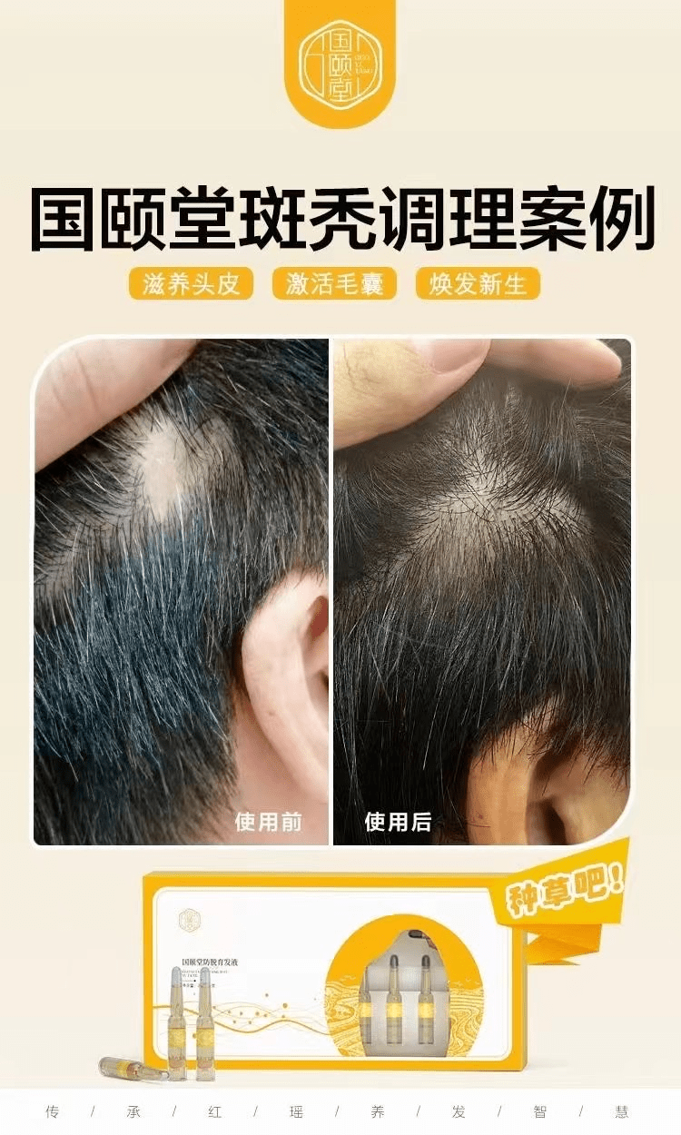 还在为大量脱发,白发,头油,头屑,头痒等头皮问题困扰吗?