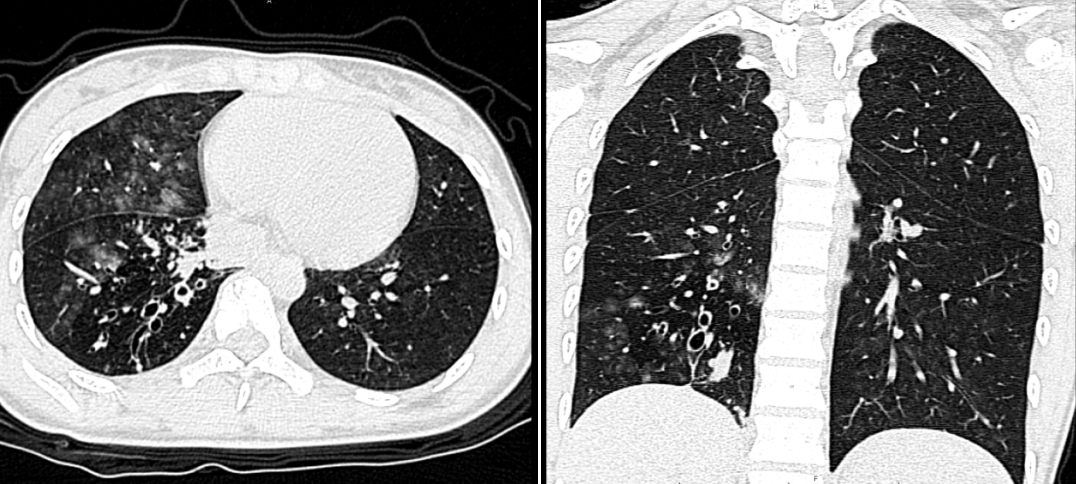 13岁女孩反复咯血一个多月元凶竟是少见先天性血管畸形